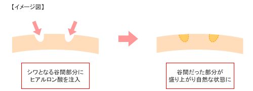 シワを消しふっくらとした肌を作るヒアルロン酸注入法