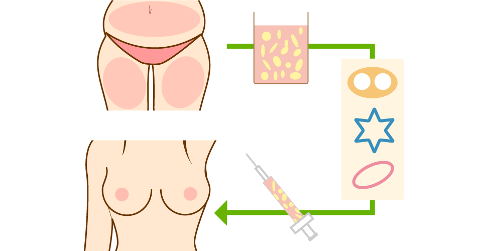イメージ図：FBC式リファインド自己脂肪注入法