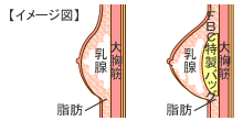 イメージ図：乳腺下法
