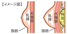 イメージ図：大胸筋下法