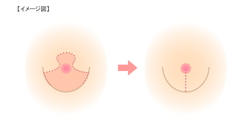 イメージ図：バスト乳房拳上術・縮小術（FBC式）