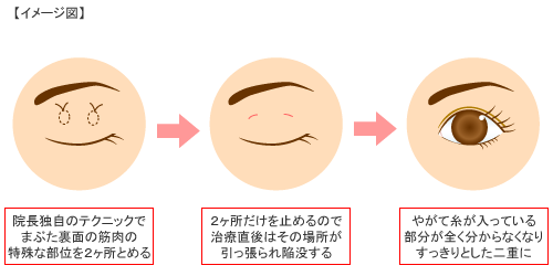 FBC式ファイン切開法