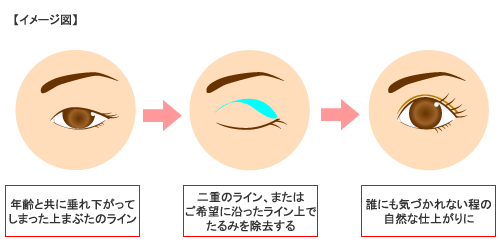 上まぶたのFBC式たるみ取り