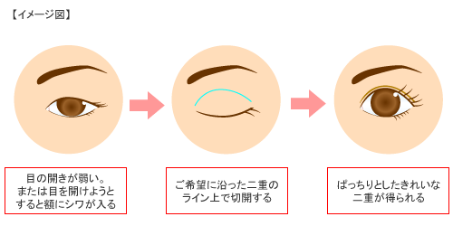 FBC式挙筋短縮術 概要