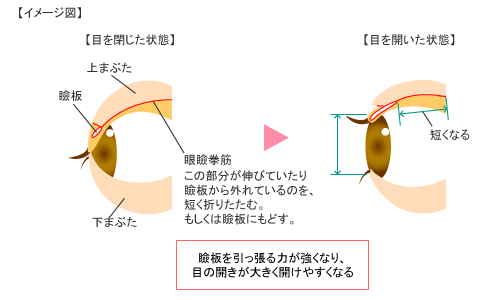 FBC式挙筋短縮術 詳細