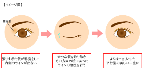 FBC式目頭切開術 概要