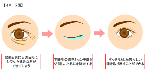 下まぶたのたるみ取り・膨らみ除去術