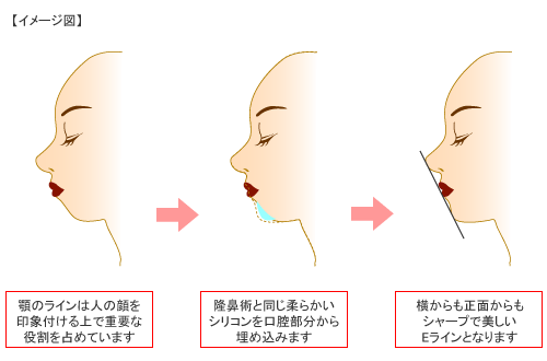 FBC式アゴの美容形成術