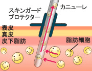 図：FBC式ファインモード永久シェイプアップ法